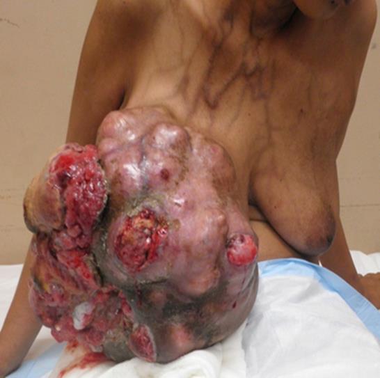 Giant-phyllodes-tumor-with-prominent-dilated-subcutaneous-vessels.jpg
